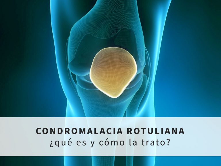 Qué es y tratamiento de la Condromalacia Rotuliana ICONICA Servicios