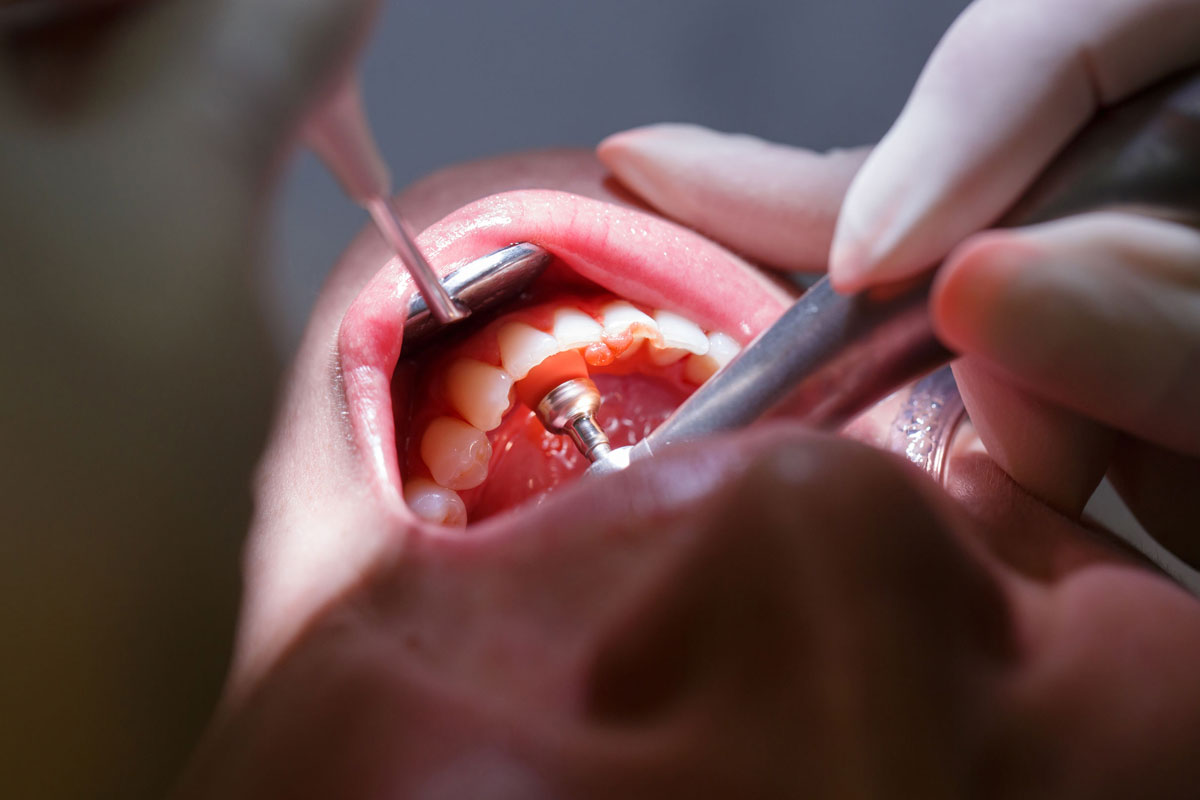 clinica dental para limpiezas dentales profundas en vigo